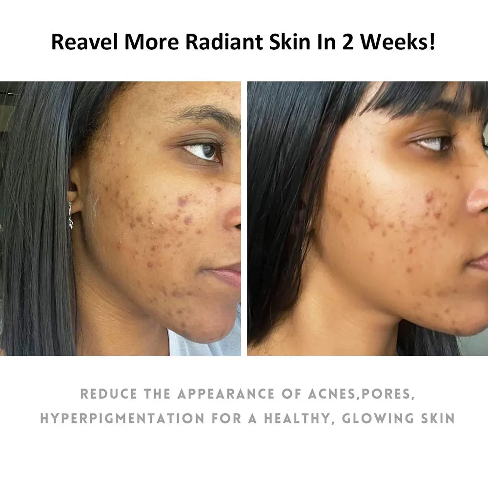 Dark Spots Toners Eraser for Dark Skin