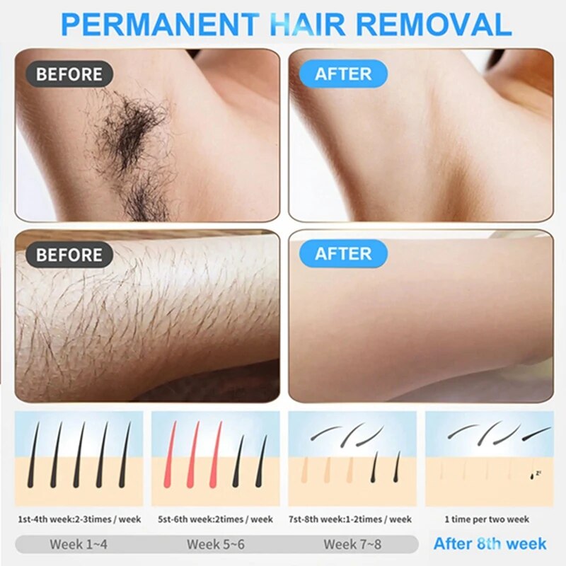 Epilator Laser-Permanent Hair Removal