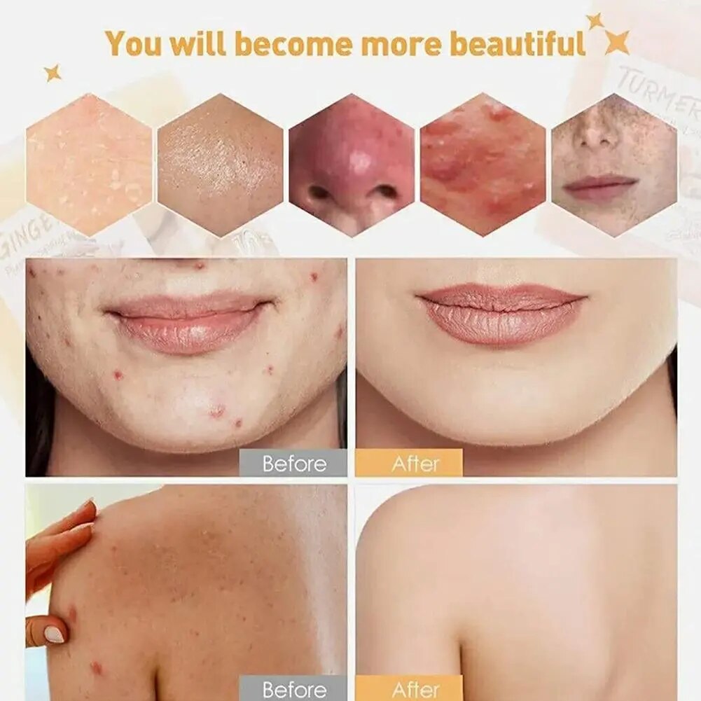 Natural Turmeric Acne Dark Spots Removal