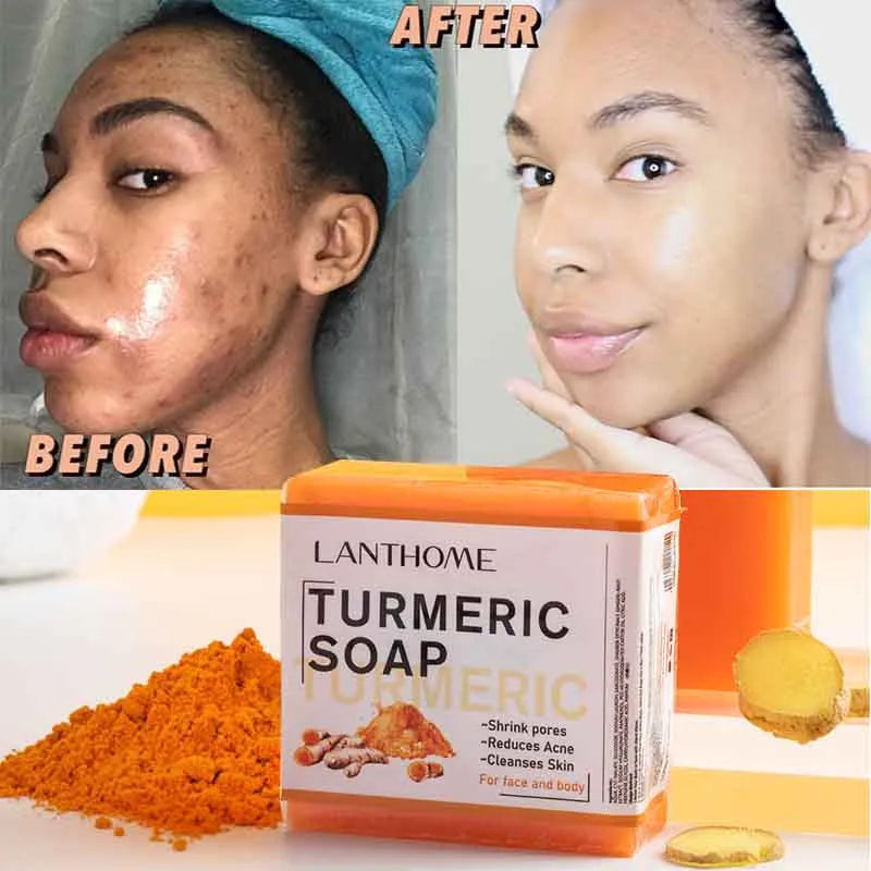 Turmeric  Anti Acne Cleansing |Remove Pimples | Dark Spots Lightening Soap